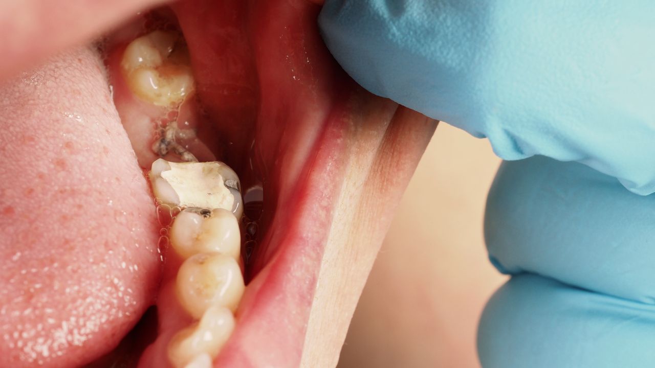Benefits of tooth-colored fillings