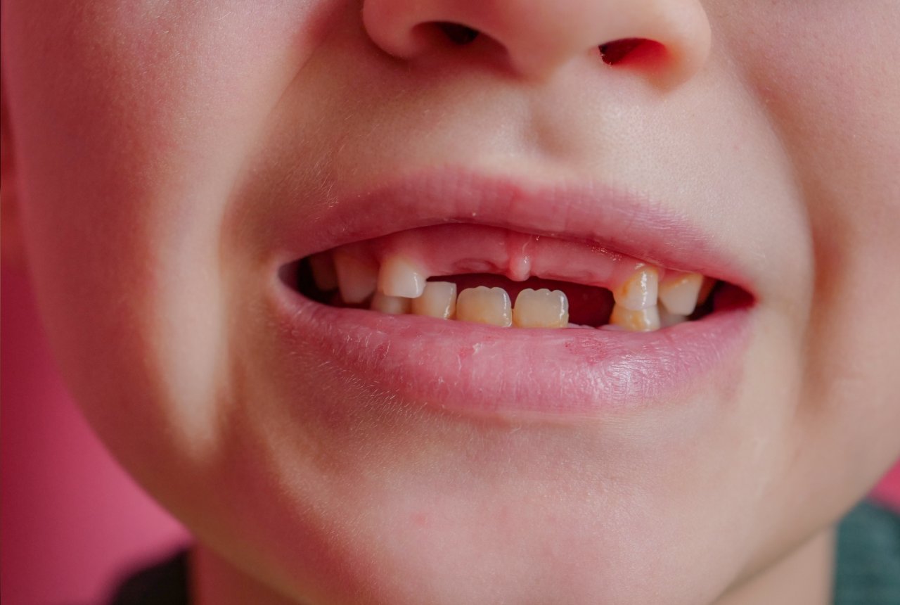 Broken or Chipped Tooth