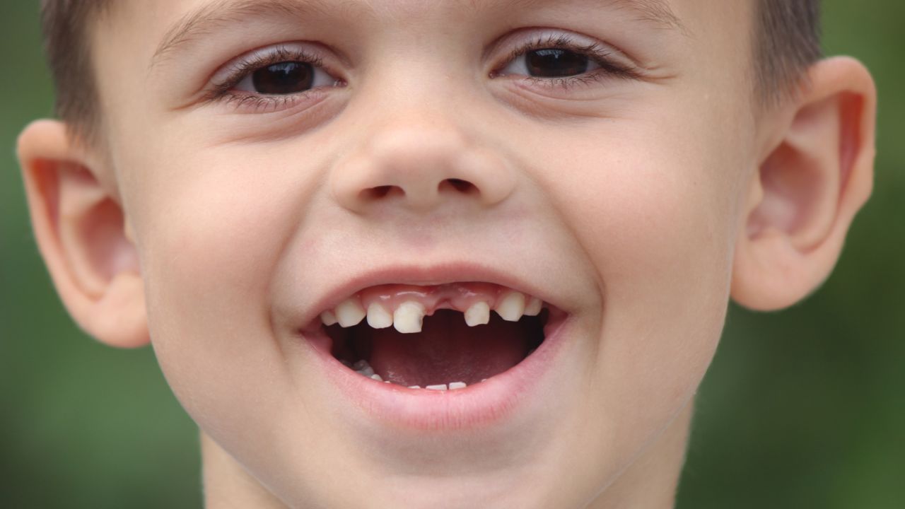 Broken or Chipped Tooth