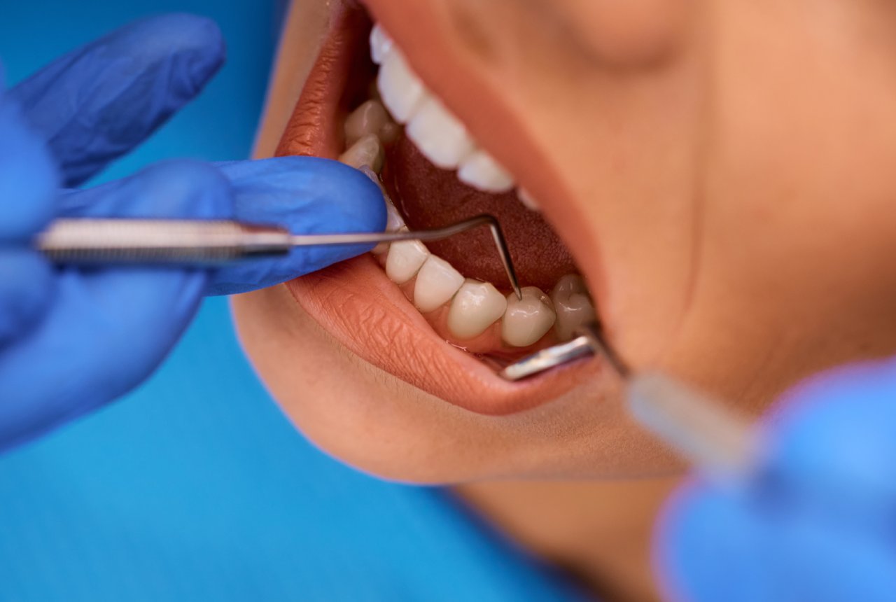 Cavity Prevention