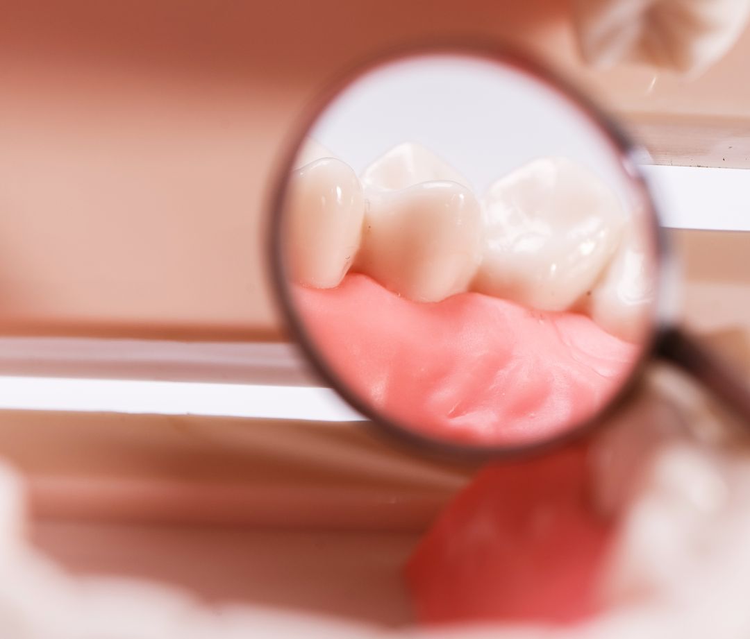 Cracked Tooth Repair