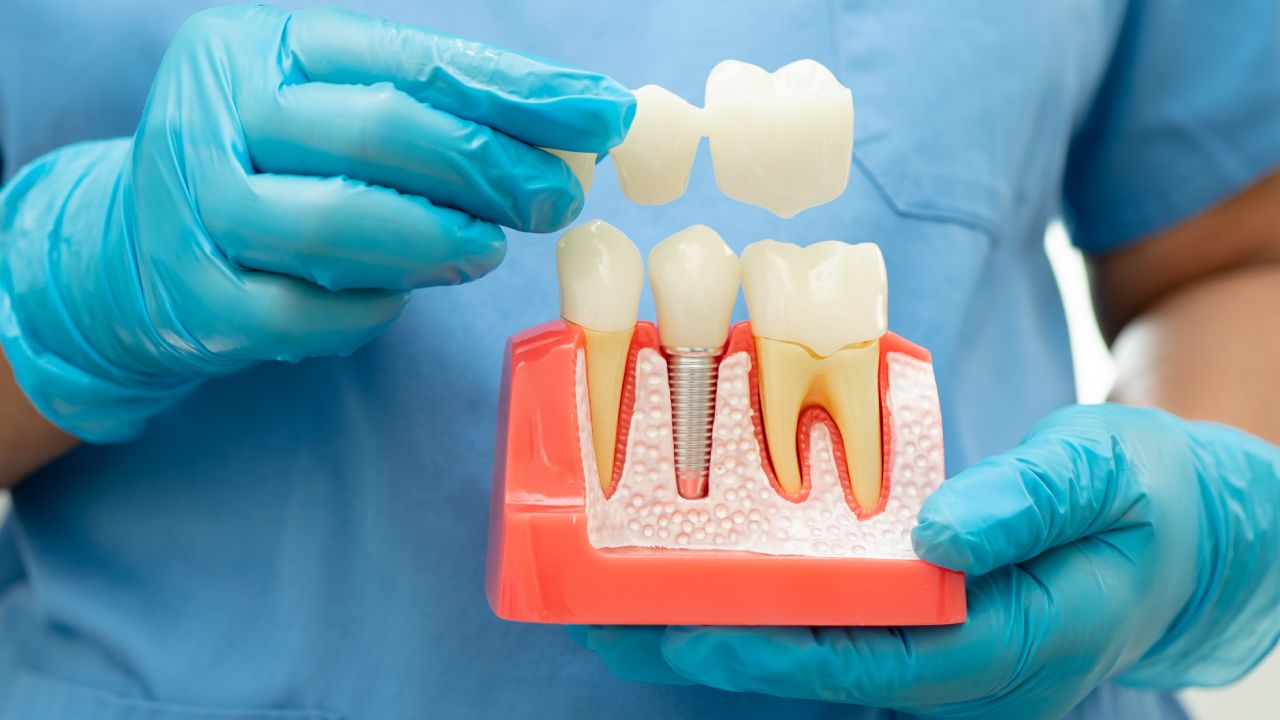 Dental Crowns