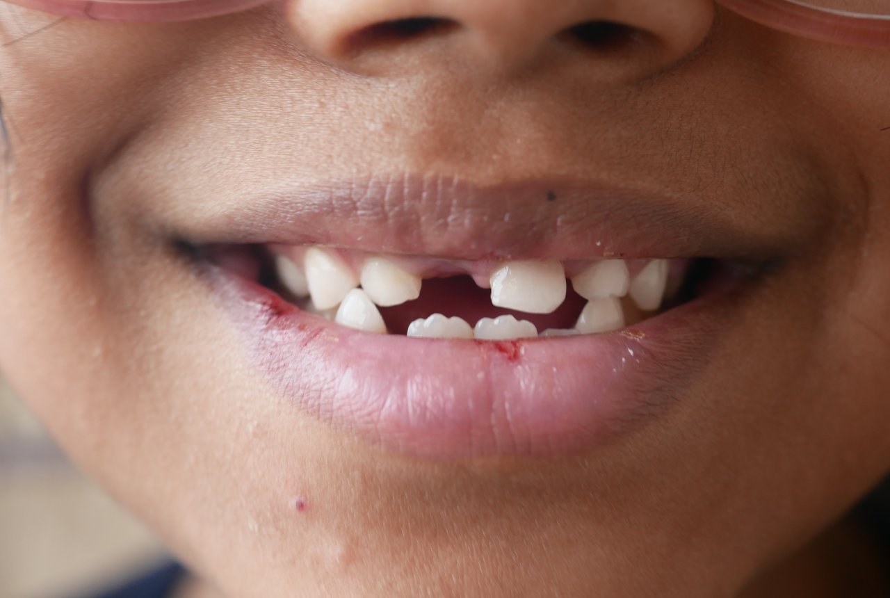Missing Teeth