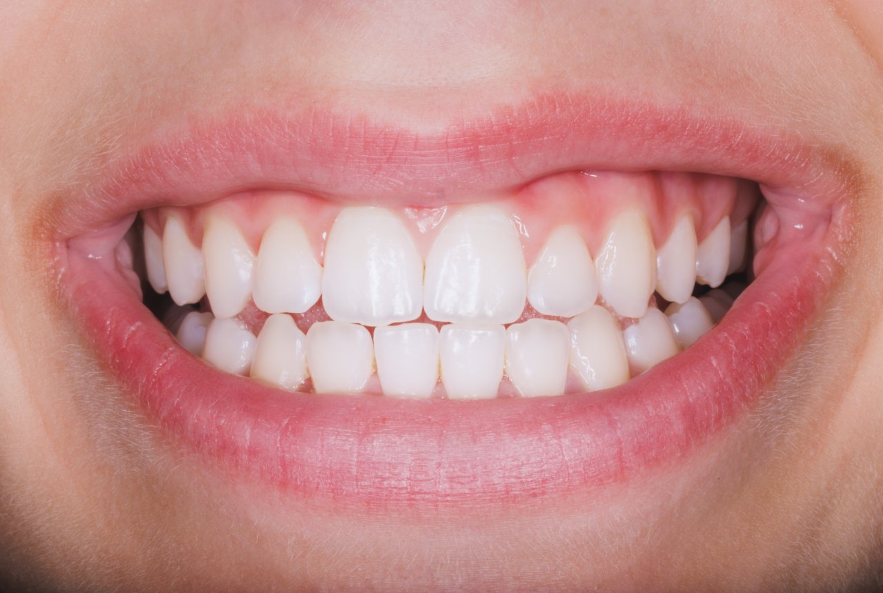 Sensitive Teeth