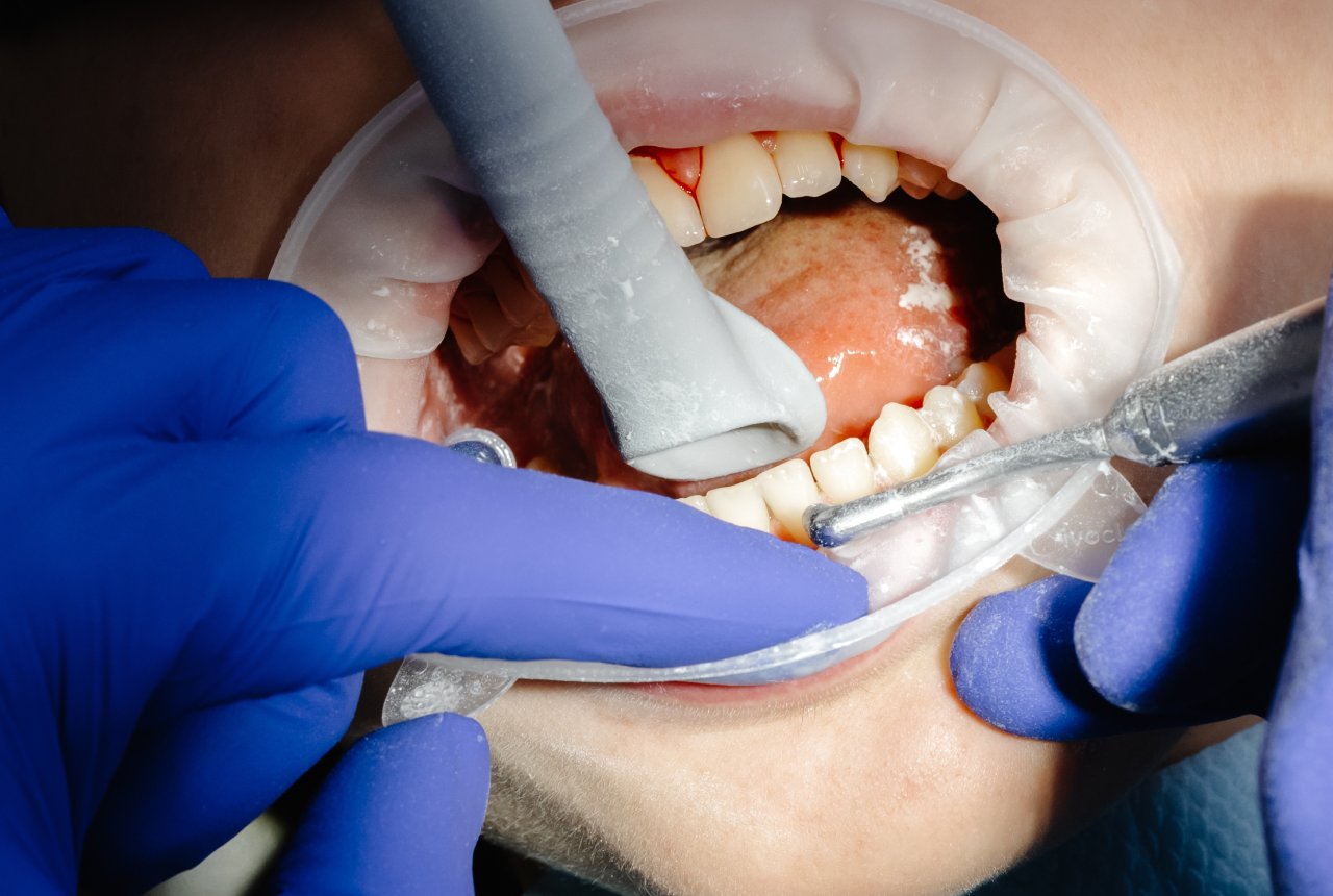 Swelling or Abscess