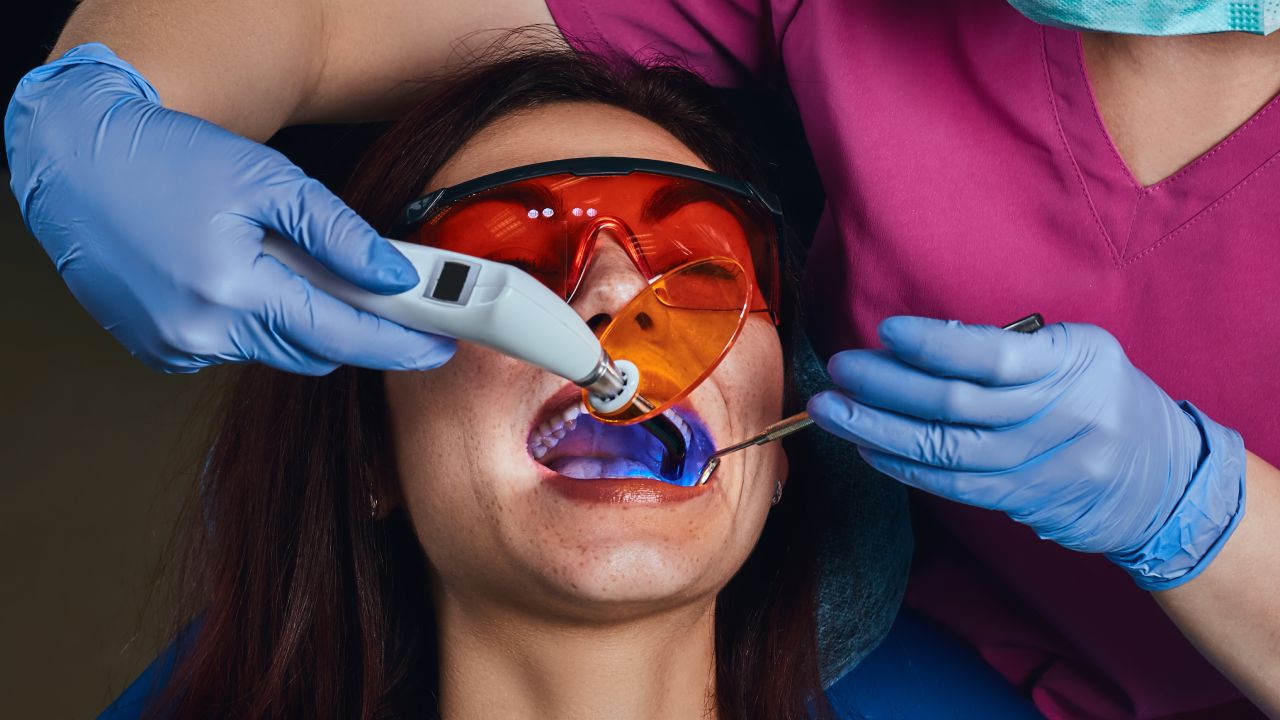 Tooth-Colored Fillings