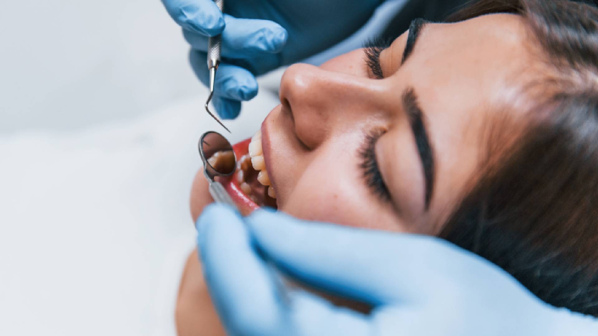 Composite Filling Service: A Safe Solution for Tooth Repair